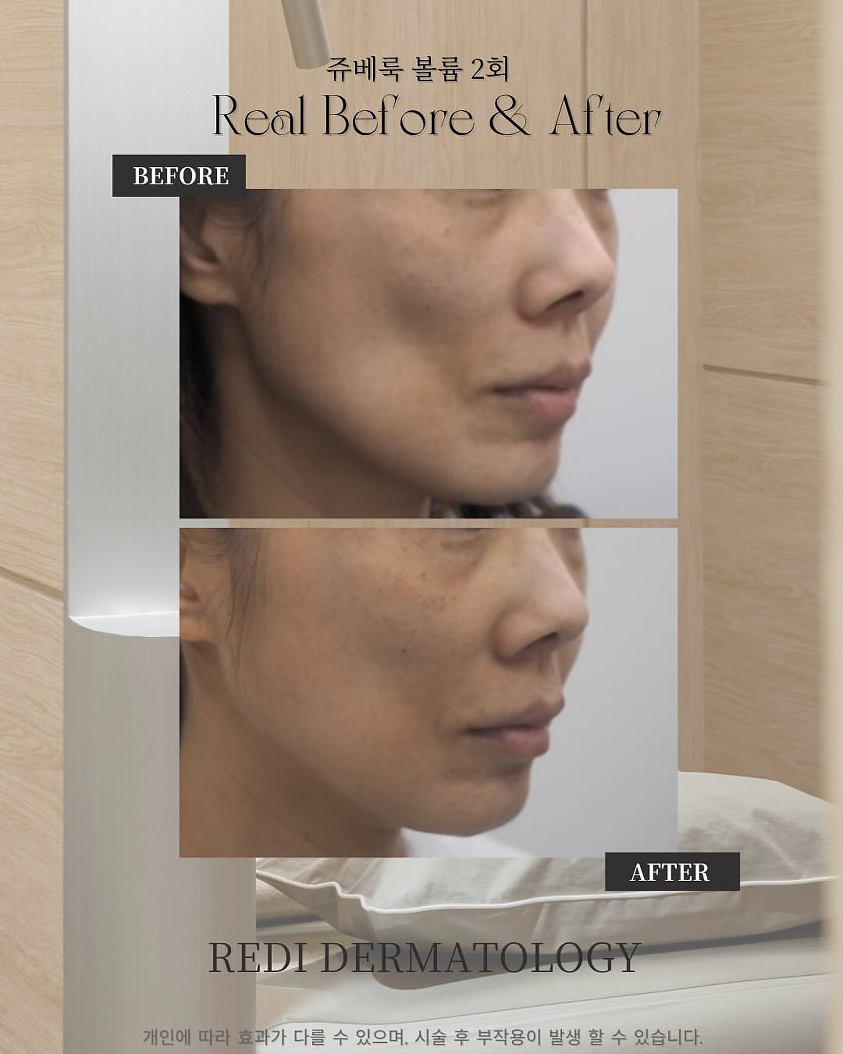 Juvelook Volume ×2 before and after — side profile volume & contour (REDI)