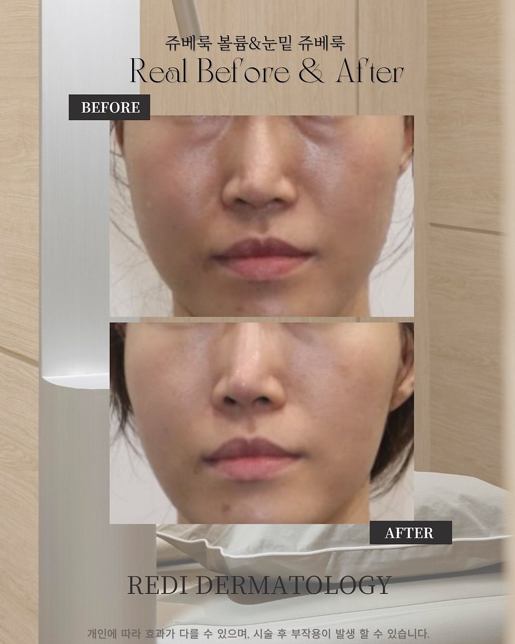 Juvelook Volume & under-eye Juvelook before and after — front view (REDI)