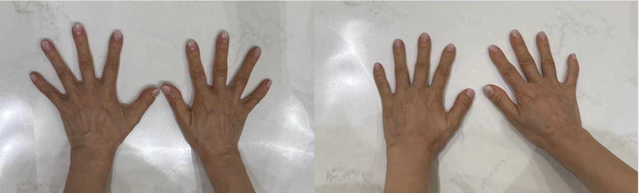 Radiesse 微晶瓷 療程前後對照(Radiesse — hands)— REDI 皮膚科實際案例