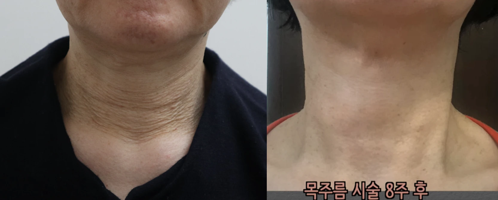 Radiesse 微晶瓷 療程前後對照(Radiesse — neck)— REDI 皮膚科實際案例